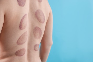 Photo of Woman after cupping therapy on light blue background, closeup. Space for text