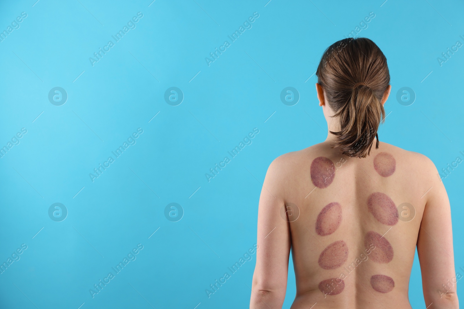 Woman after cupping therapy on light blue background, back view. Space for text Photo of Woman after cupping therapy on light blue background, back view. Space for text