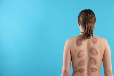 Photo of Woman after cupping therapy on light blue background, back view. Space for text