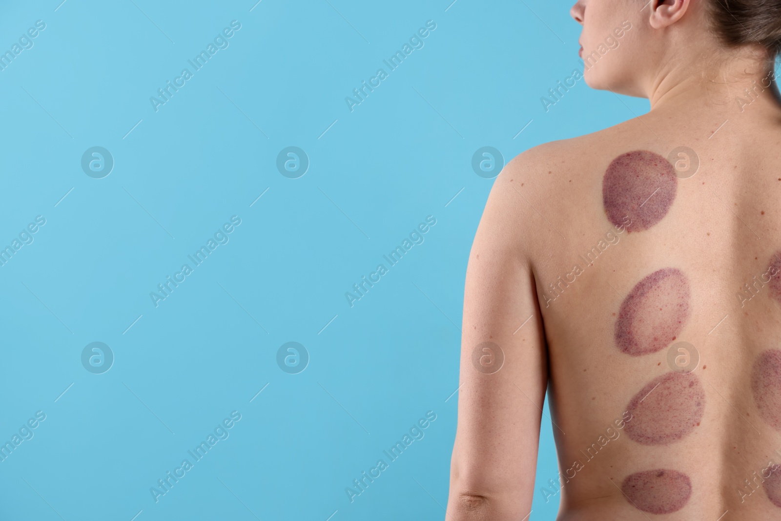 Woman after cupping therapy on light blue background, closeup. Space for text Photo of Woman after cupping therapy on light blue background, closeup. Space for text