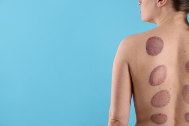 Photo of Woman after cupping therapy on light blue background, closeup. Space for text