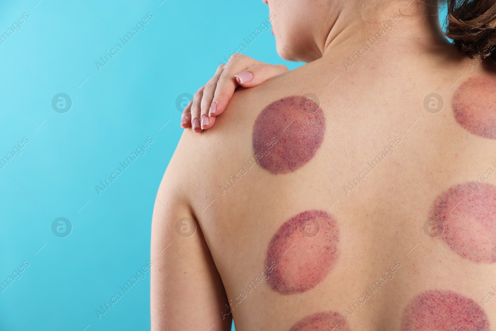 Woman after cupping therapy on light blue background, closeup. Space for text Photo of Woman after cupping therapy on light blue background, closeup. Space for text