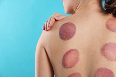 Photo of Woman after cupping therapy on light blue background, closeup. Space for text