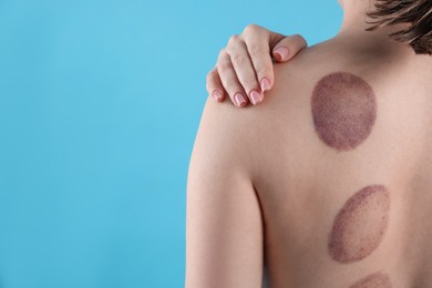 Photo of Woman after cupping therapy on light blue background, closeup. Space for text