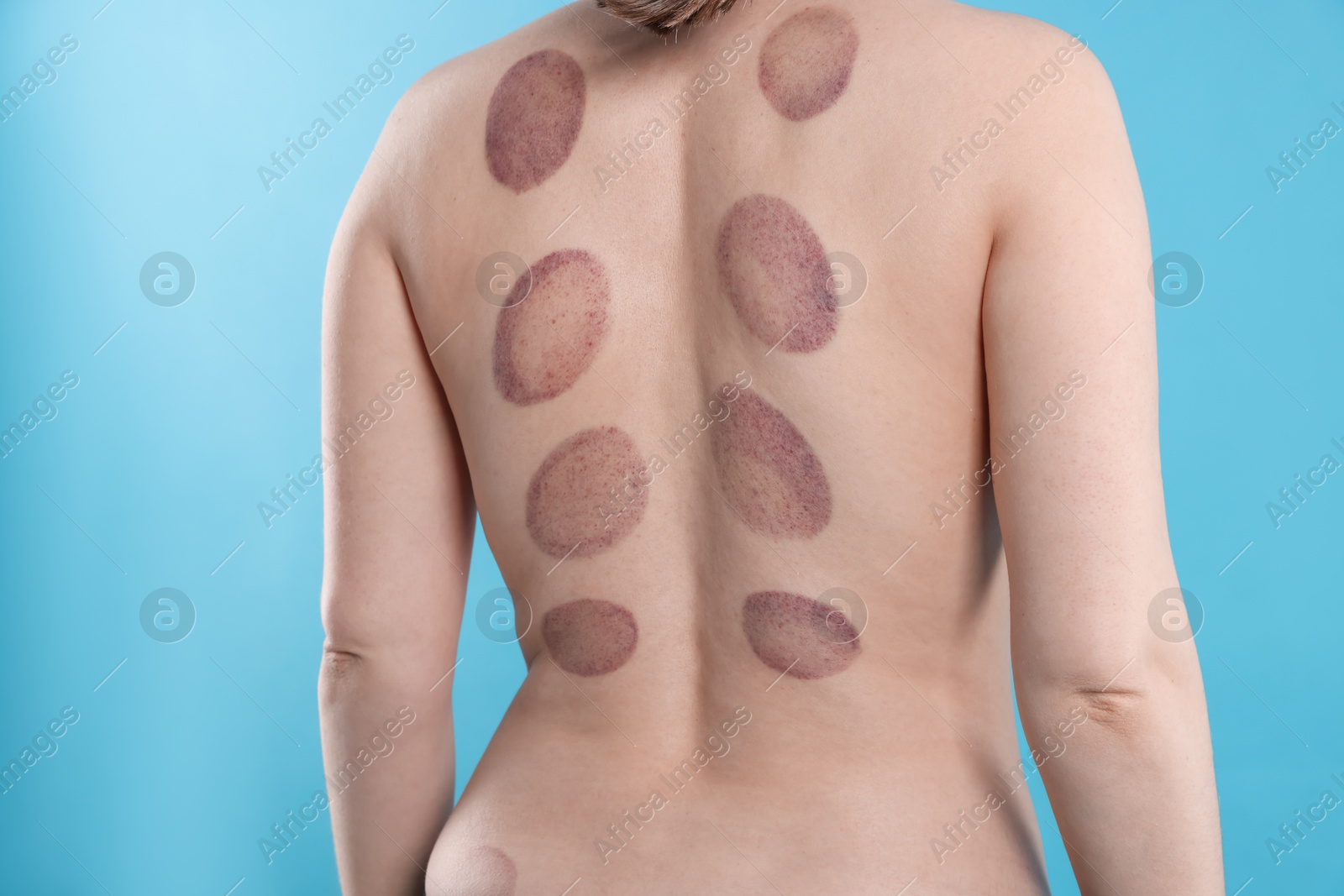Woman after cupping therapy on light blue background, closeup Photo of Woman after cupping therapy on light blue background, closeup