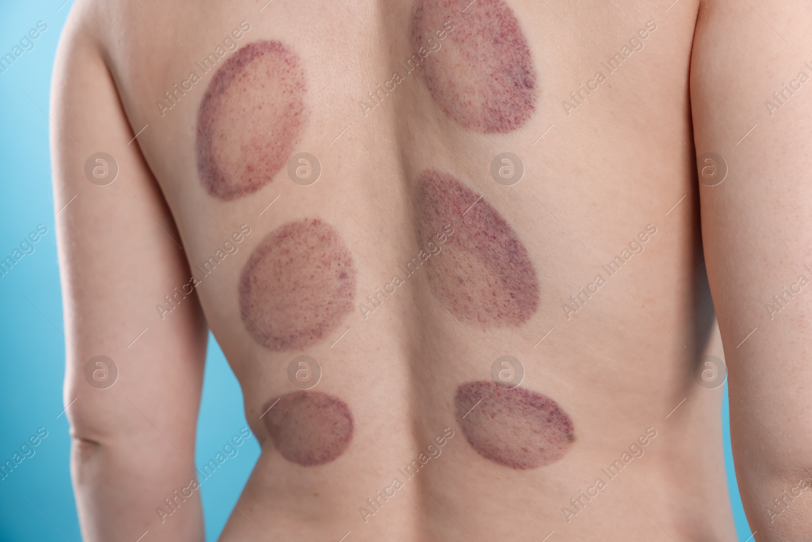 Woman after cupping therapy on light blue background, closeup Photo of Woman after cupping therapy on light blue background, closeup