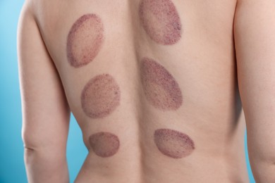 Photo of Woman after cupping therapy on light blue background, closeup