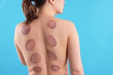 Photo of Woman after cupping therapy on light blue background, closeup