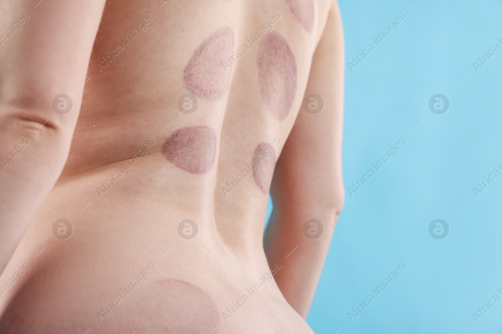 Woman after cupping therapy on light blue background, closeup. Space for text Photo of Woman after cupping therapy on light blue background, closeup. Space for text