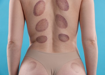 Photo of Woman after cupping therapy on light blue background, closeup