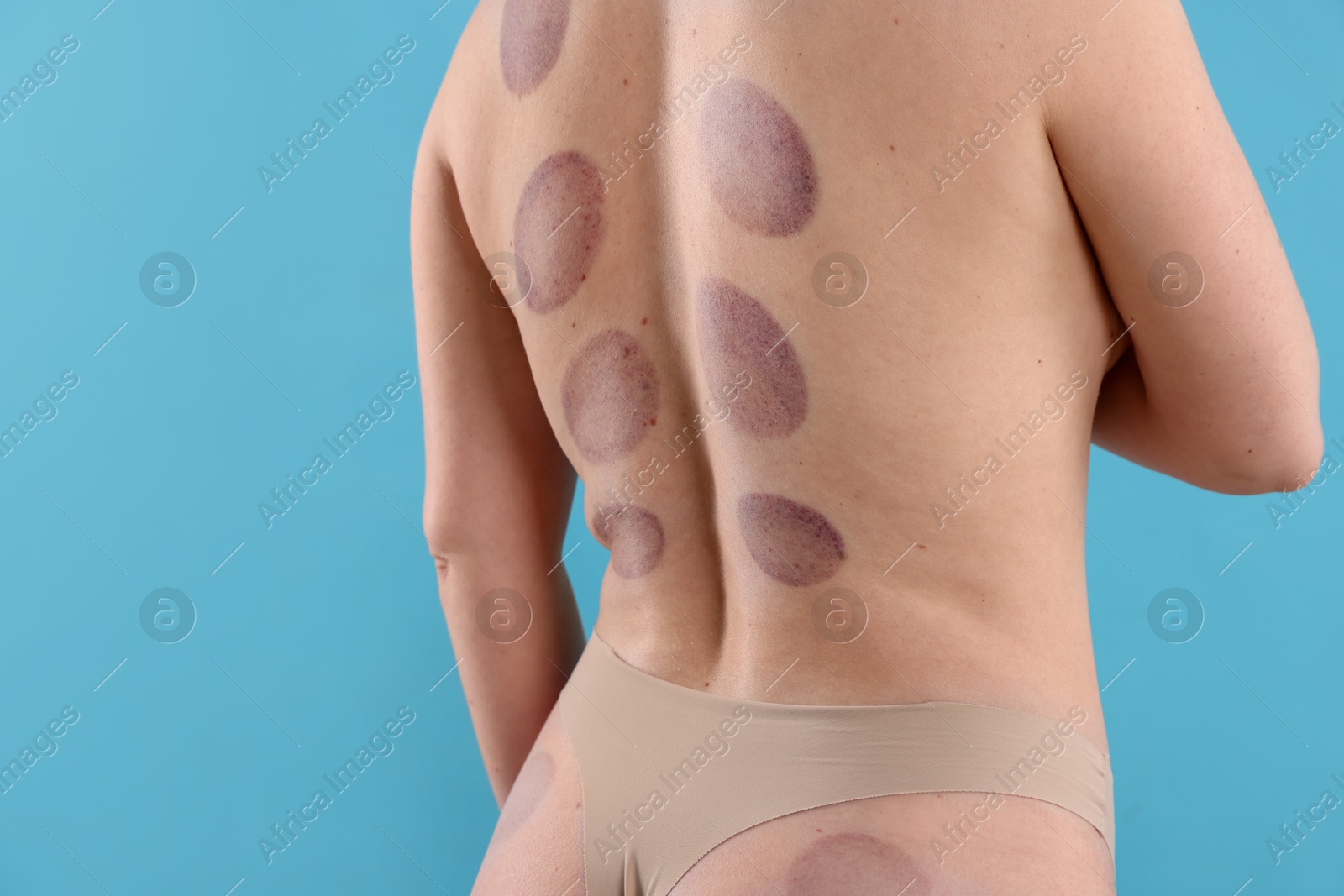Woman after cupping therapy on light blue background, closeup Photo of Woman after cupping therapy on light blue background, closeup