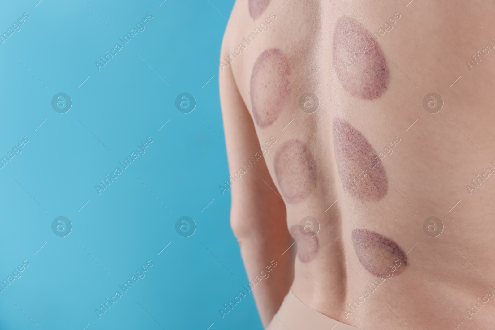 Woman after cupping therapy on light blue background, closeup. Space for text Photo of Woman after cupping therapy on light blue background, closeup. Space for text