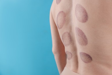 Photo of Woman after cupping therapy on light blue background, closeup. Space for text