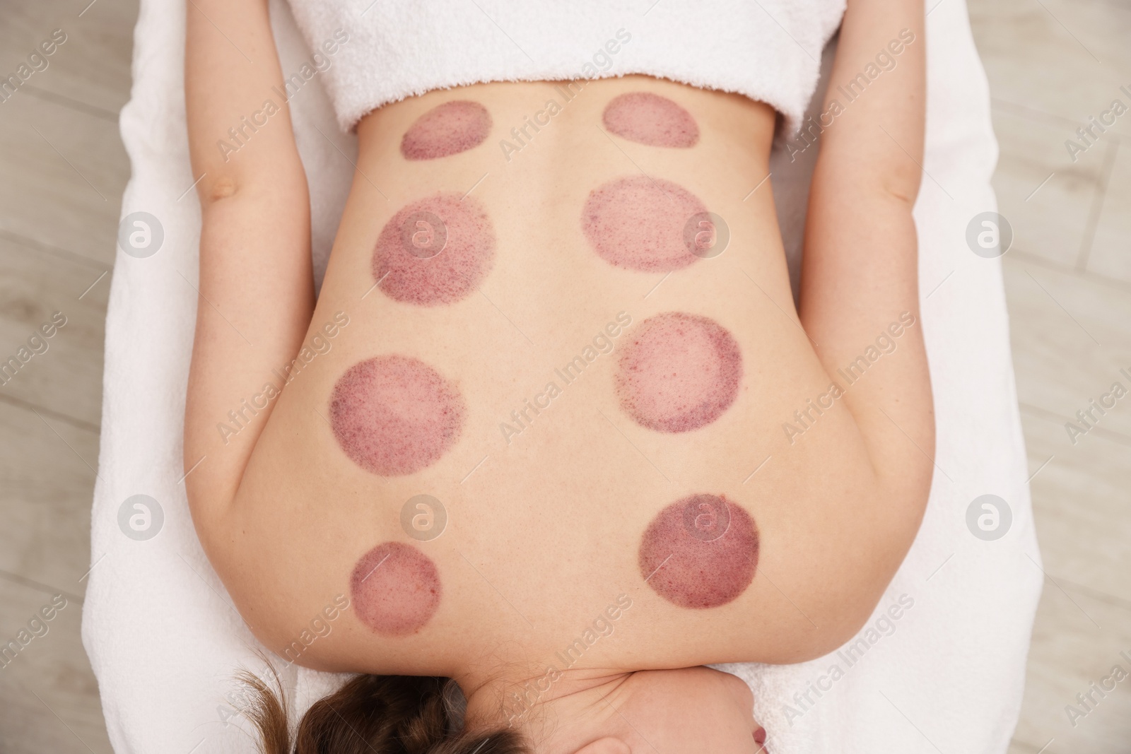 Woman after cupping therapy in spa salon, top view Photo of Woman after cupping therapy in spa salon, top view