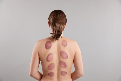 Photo of Woman after cupping therapy on gray background