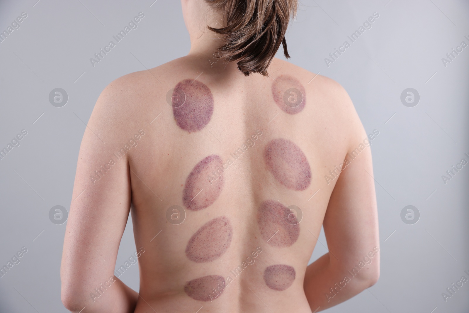 Woman after cupping therapy on gray background, closeup Photo of Woman after cupping therapy on gray background, closeup