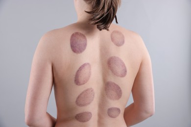 Photo of Woman after cupping therapy on gray background, closeup