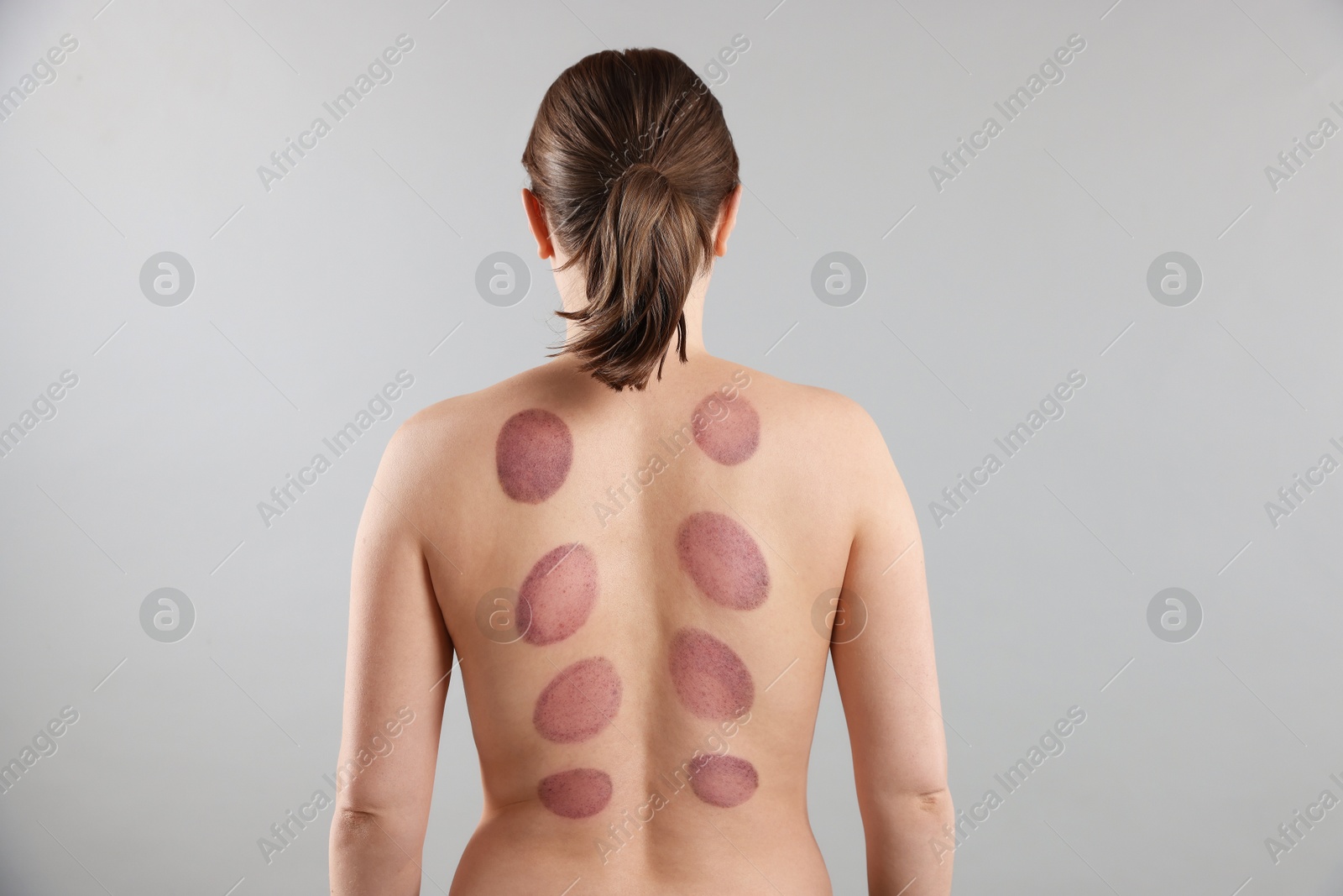 Woman after cupping therapy on gray background Photo of Woman after cupping therapy on gray background