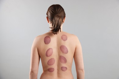 Photo of Woman after cupping therapy on gray background