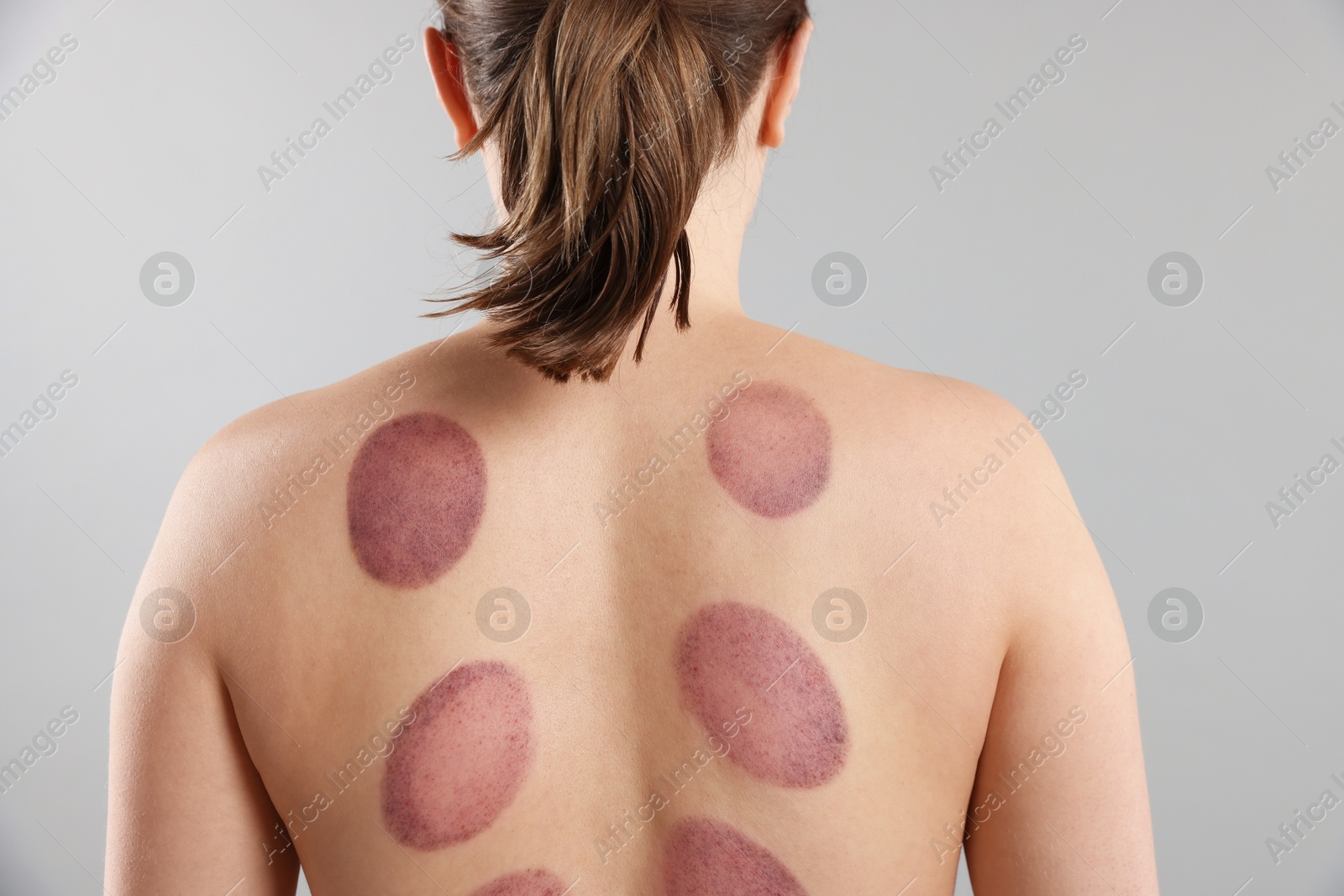 Woman after cupping therapy on gray background, closeup Photo of Woman after cupping therapy on gray background, closeup