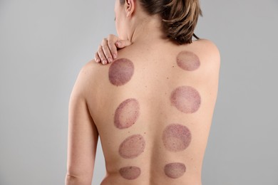 Photo of Woman after cupping therapy on gray background, closeup