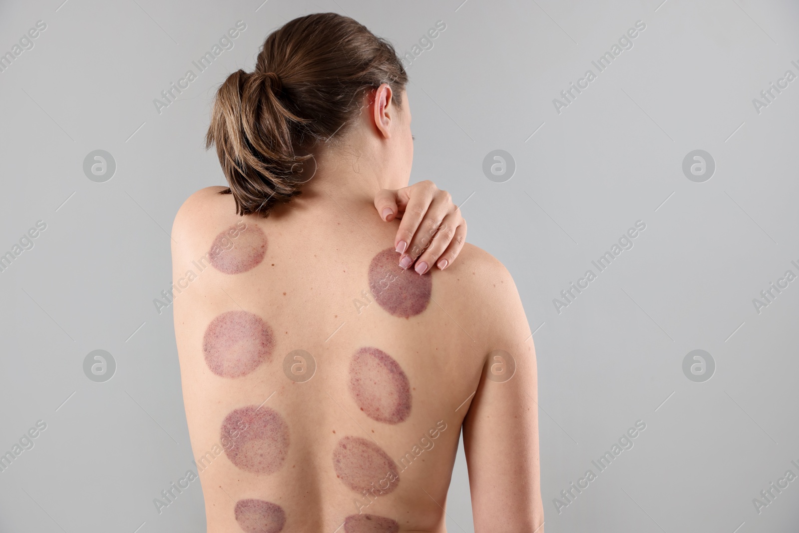 Woman after cupping therapy on gray background, back view Photo of Woman after cupping therapy on gray background, back view