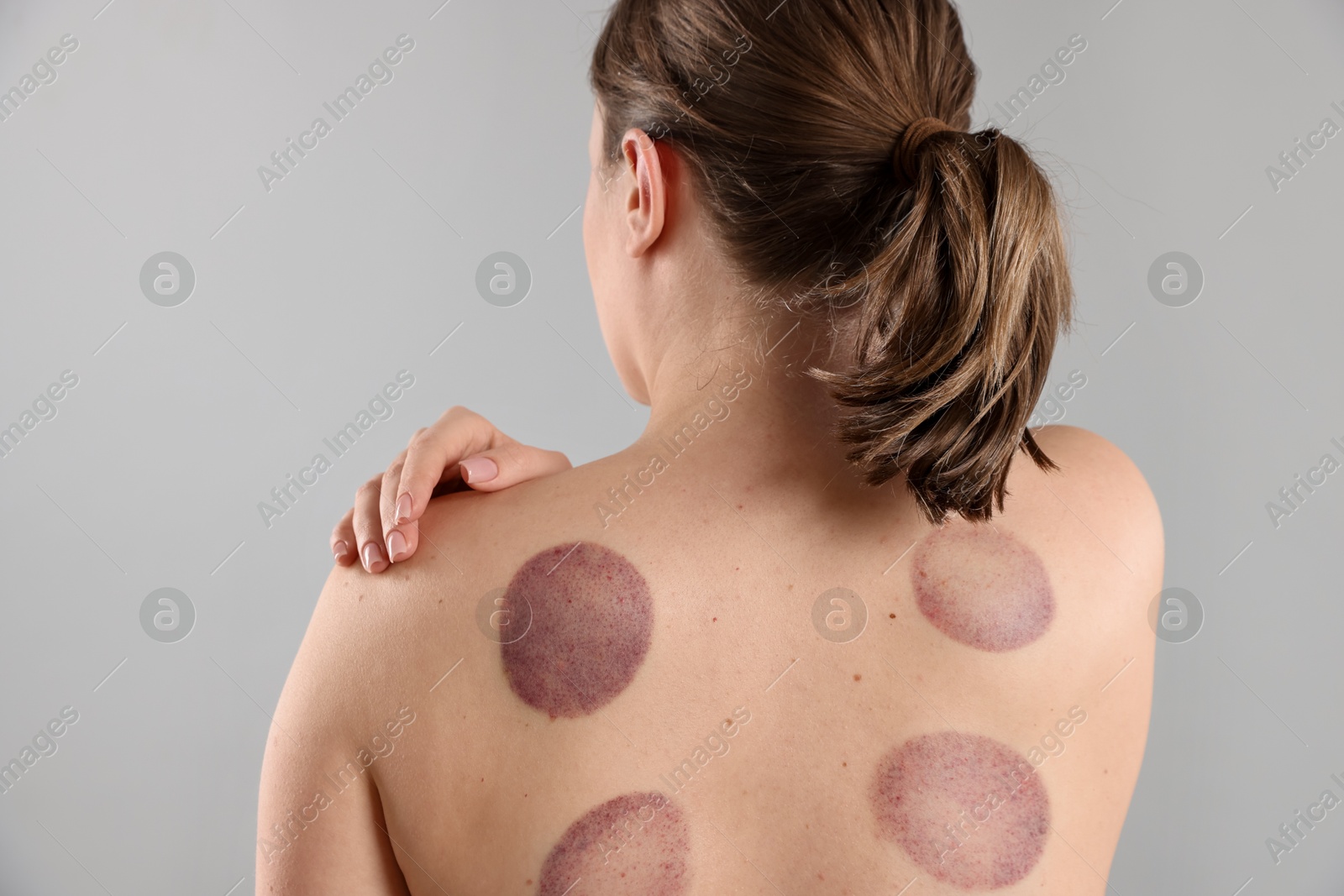Woman after cupping therapy on gray background, back view Photo of Woman after cupping therapy on gray background, back view