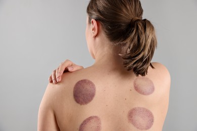 Photo of Woman after cupping therapy on gray background, back view