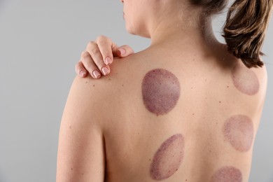 Photo of Woman after cupping therapy on gray background, closeup