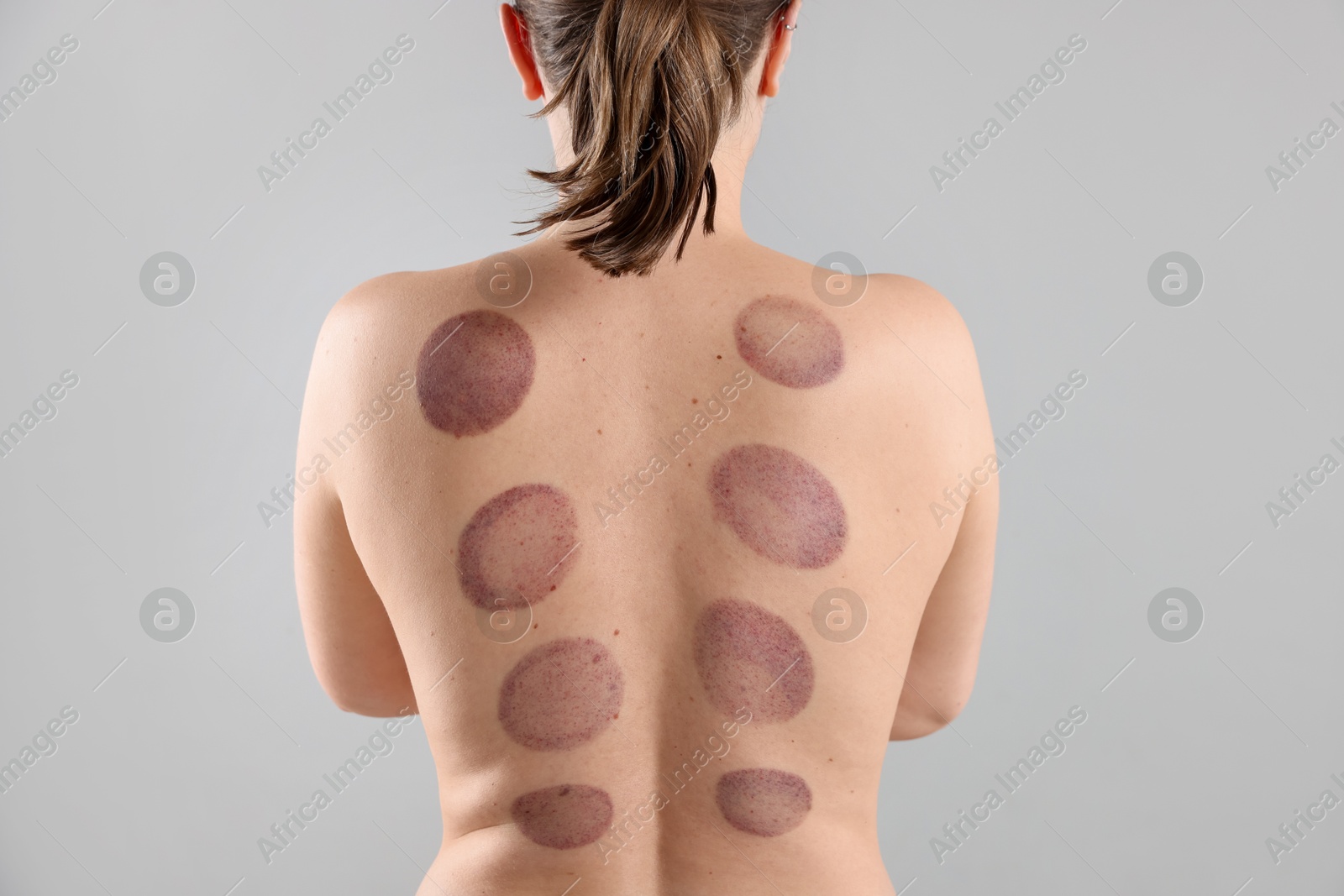 Woman after cupping therapy on gray background, closeup Photo of Woman after cupping therapy on gray background, closeup