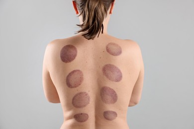 Photo of Woman after cupping therapy on gray background, closeup