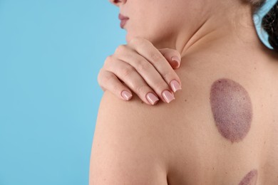 Photo of Woman after cupping therapy on light blue background, closeup. Space for text