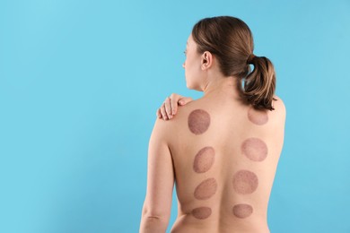 Photo of Woman after cupping therapy on light blue background, back view. Space for text