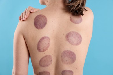 Photo of Woman after cupping therapy on light blue background, closeup