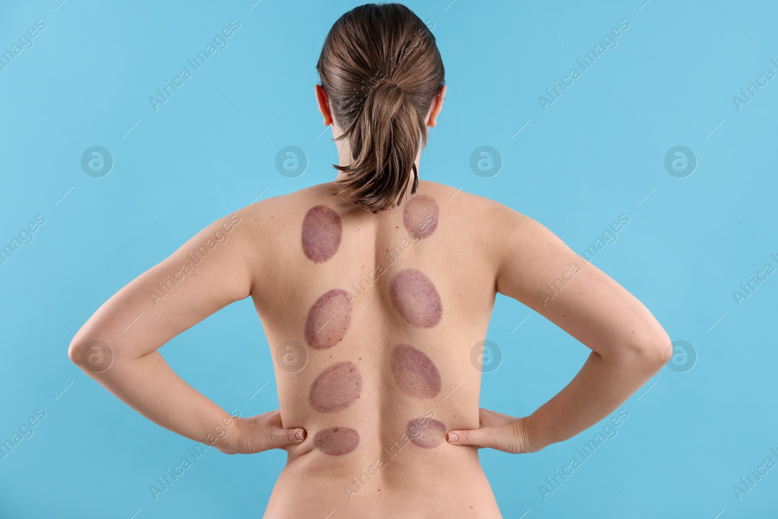 Woman after cupping therapy on light blue background, back view Photo of Woman after cupping therapy on light blue background, back view