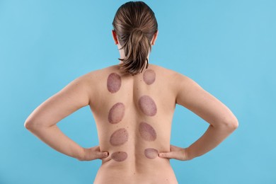 Photo of Woman after cupping therapy on light blue background, back view