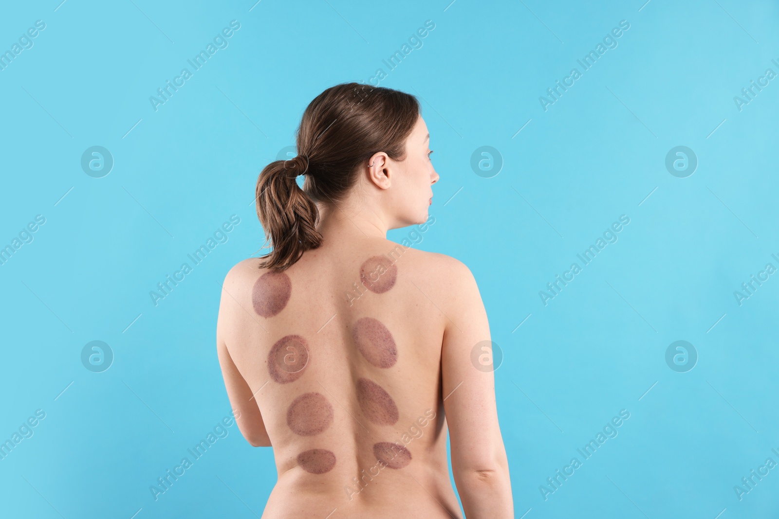 Woman after cupping therapy on light blue background, back view Photo of Woman after cupping therapy on light blue background, back view