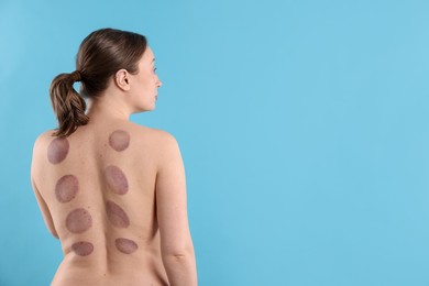 Photo of Woman after cupping therapy on light blue background, space for text