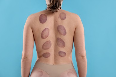 Photo of Woman after cupping therapy on light blue background, closeup