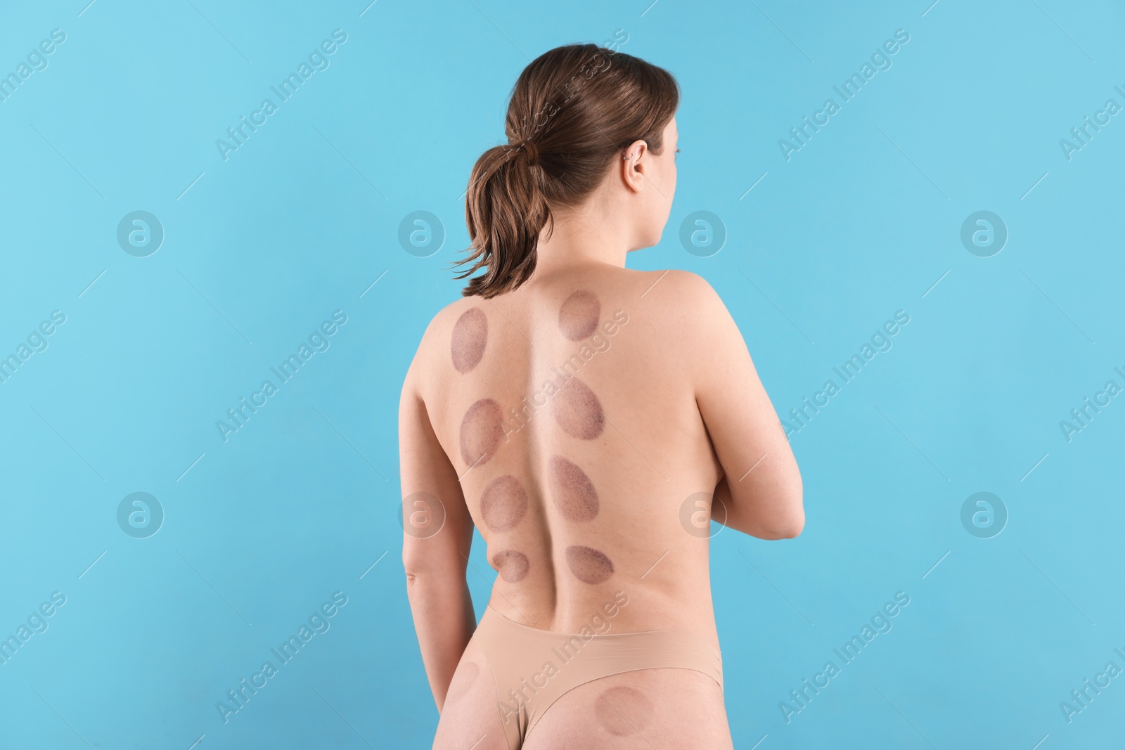 Woman after cupping therapy on light blue background Photo of Woman after cupping therapy on light blue background