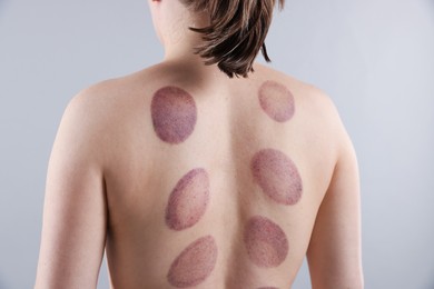 Photo of Woman after cupping therapy on gray background, closeup