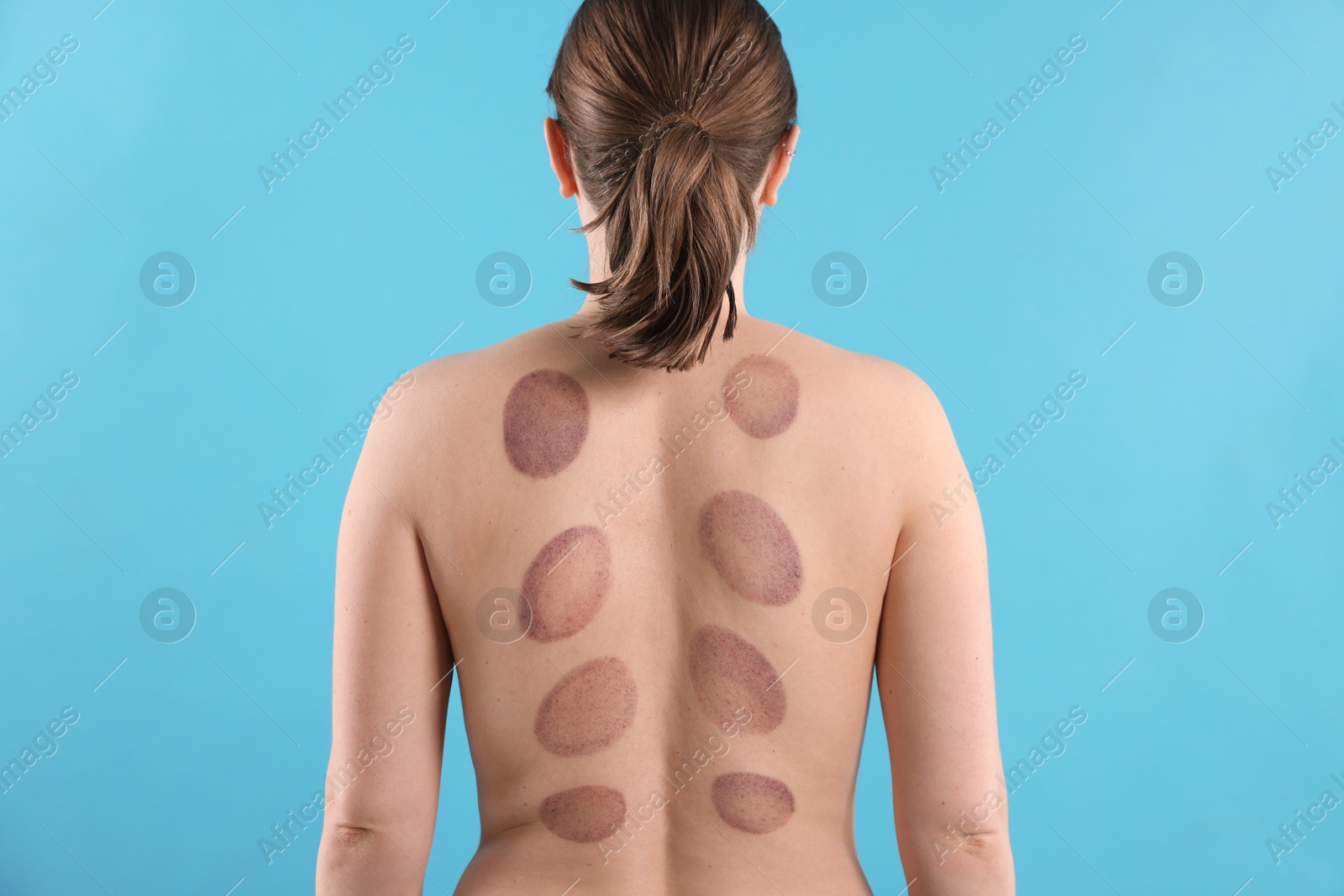 Woman after cupping therapy on light blue background, back view Photo of Woman after cupping therapy on light blue background, back view
