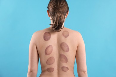 Photo of Woman after cupping therapy on light blue background, back view
