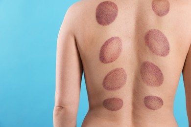 Photo of Woman after cupping therapy on light blue background, closeup