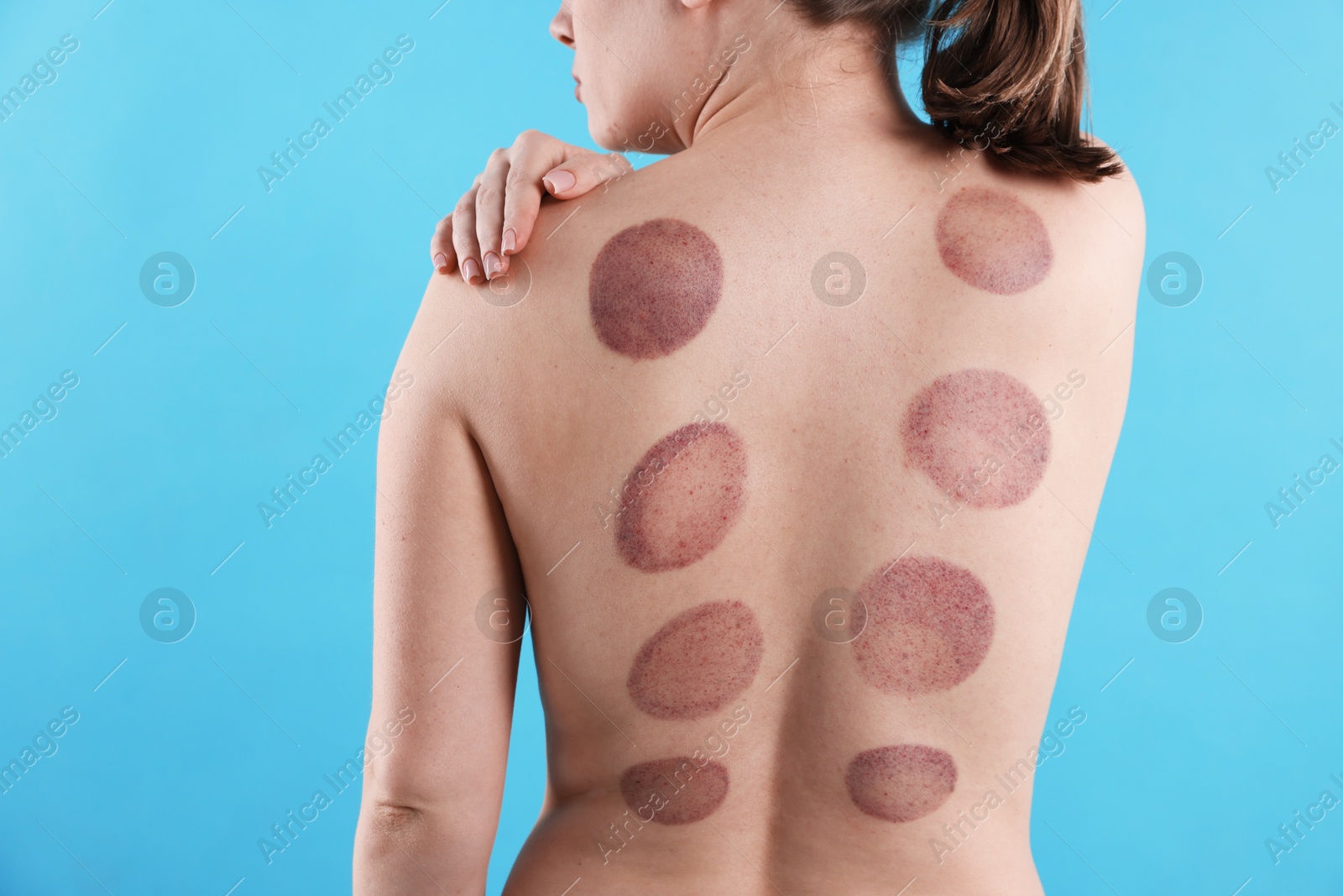 Woman after cupping therapy on light blue background, closeup Photo of Woman after cupping therapy on light blue background, closeup