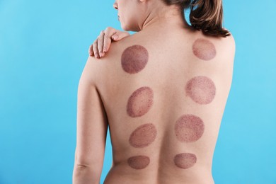 Photo of Woman after cupping therapy on light blue background, closeup