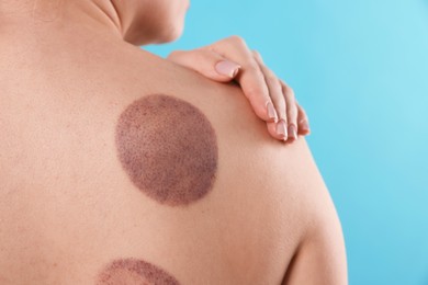 Photo of Woman after cupping therapy on light blue background, closeup