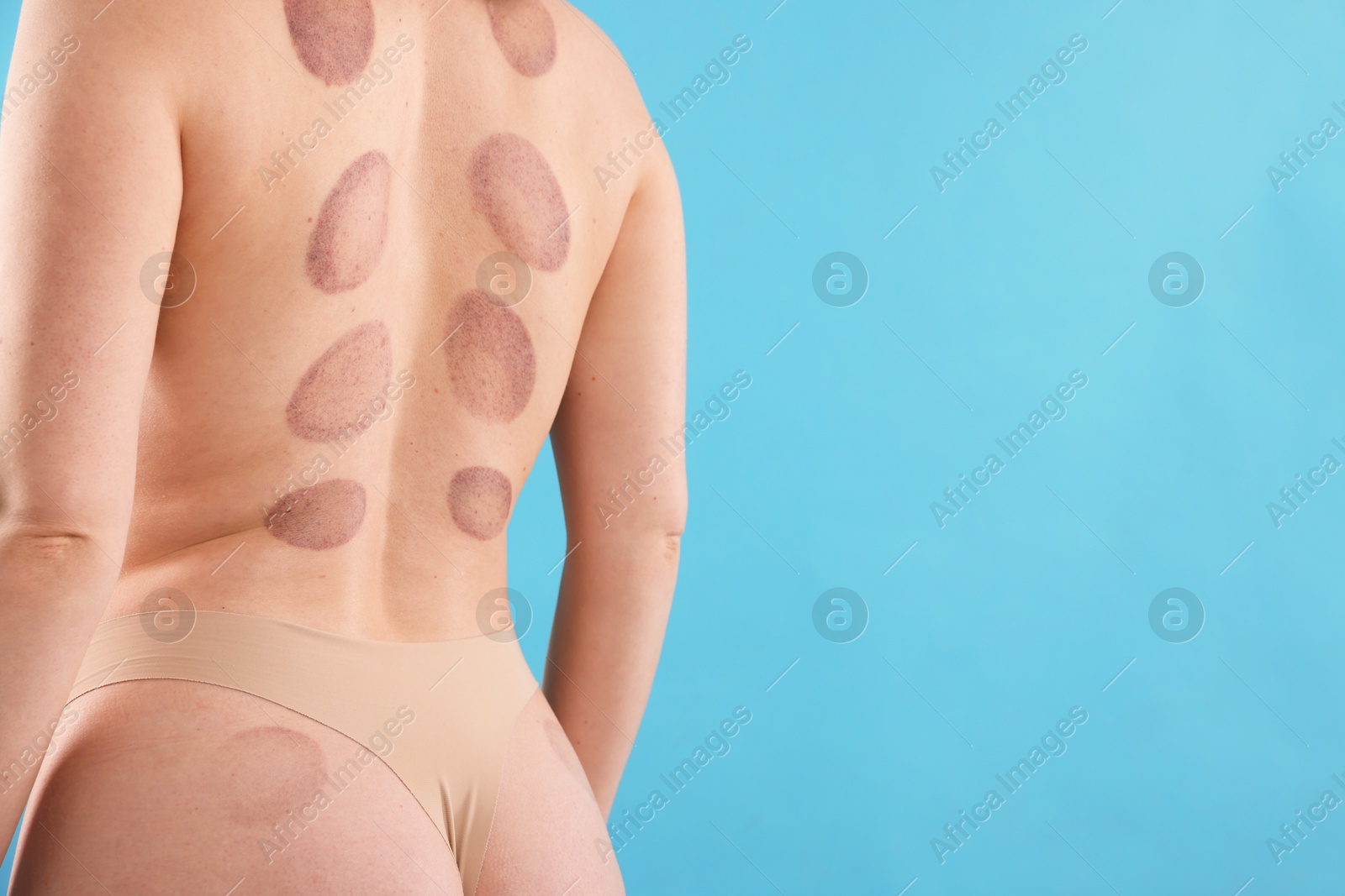Woman after cupping therapy on light blue background, closeup. Space for text Photo of Woman after cupping therapy on light blue background, closeup. Space for text