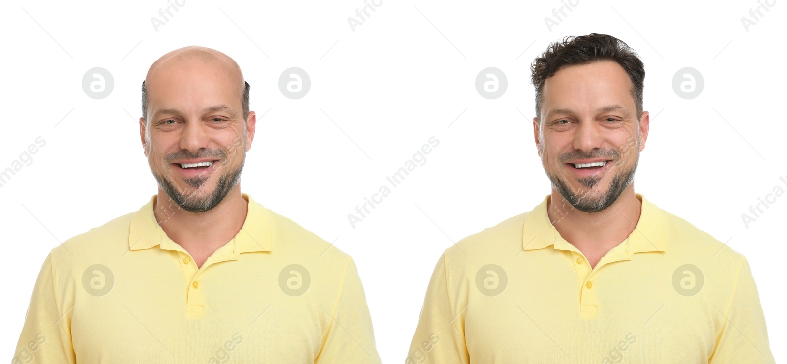 Baldness. Man before and after wearing wig or hair treatment, collage Image of Baldness. Man before and after wearing wig or hair treatment, collage