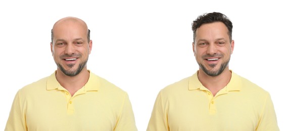 Image of Baldness. Man before and after wearing wig or hair treatment, collage